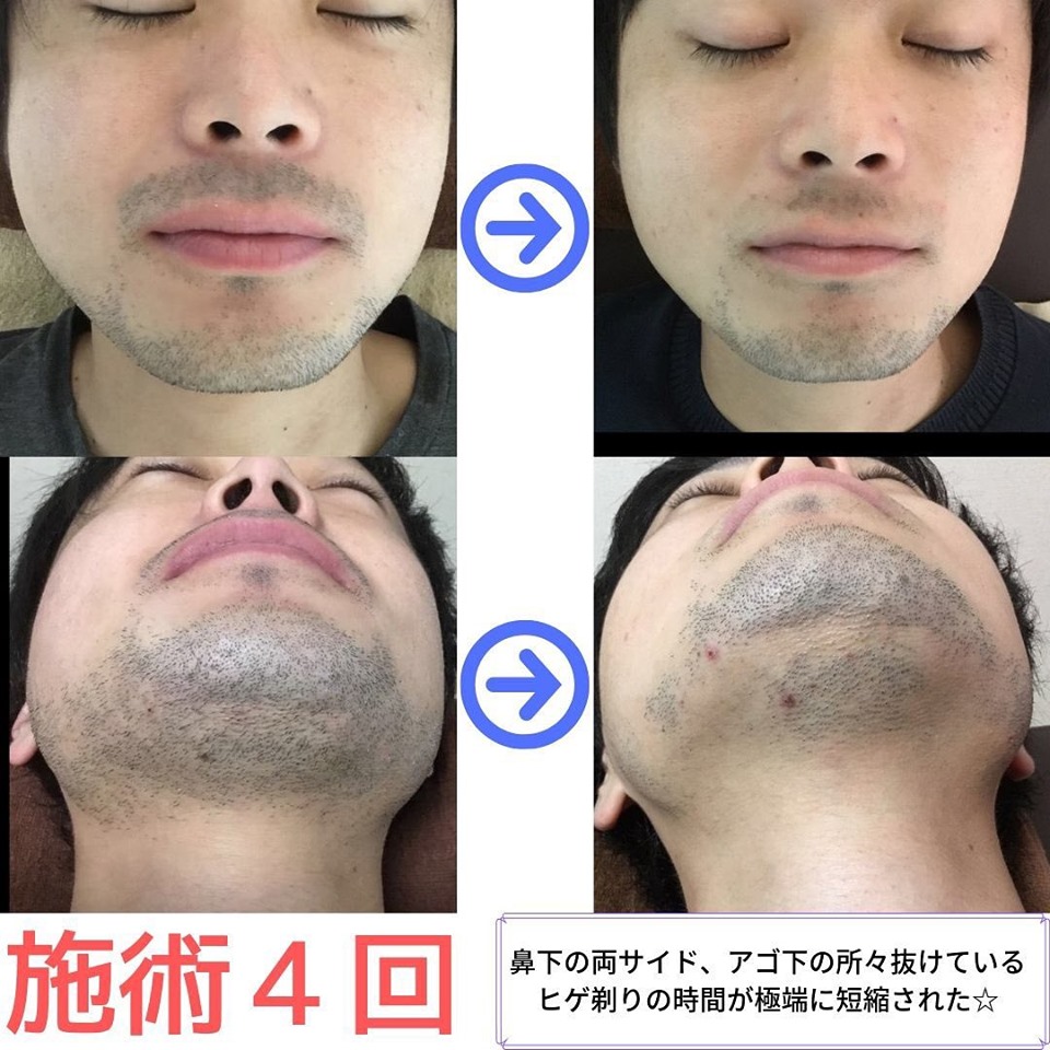 ヒゲ脱毛４回のビフォーアフター写真です